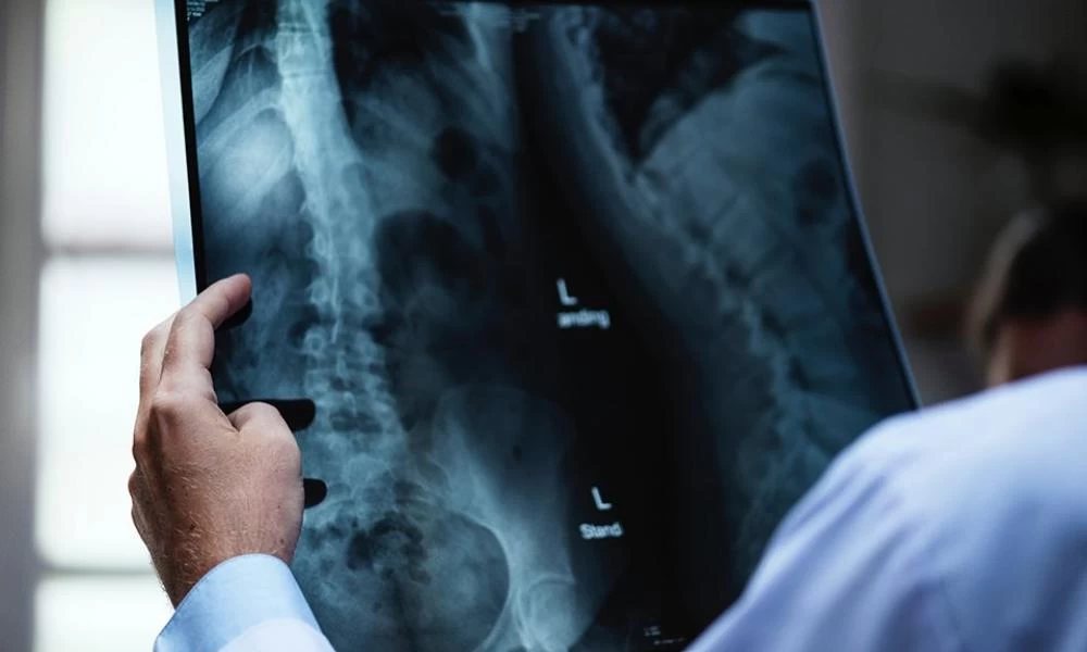 Μεγάλος κίνδυνος πνευμονικής ίνωσης για όσους νόσησαν από κορονοϊό